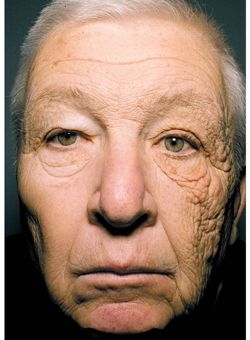 À droite, le visage de cet homme de 69 ans a vieilli de manière accélérée sous les effets des rayons UVA , exposé à travers la vitre son camion. crédit: The New England Journal of Medicine ©2012